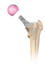 Functional Assessment Select the appropriate femoral head and place it onto the selected stem. Apply finger pressure to firmly seat the head onto the stem.