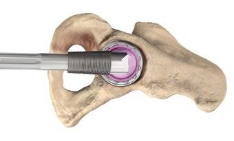 opening of the acetabular insert (i.e., the axis of the femoral neck is perpendicular to the insert face).