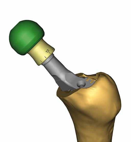 The 8 Guiding Thoughts of the BioBall System BioBall Adapter System Offset Careful removal of the existing head from the hip stem using the head extractor with appropriate separating wedge.