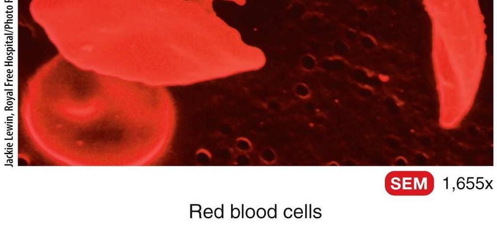 red blood cells to bend into a sickle shape