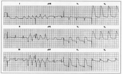 Warning Arrhythmias What happens to start an episode of ACS?