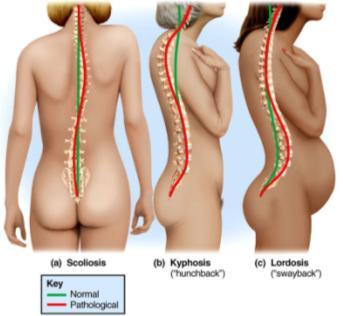 Abnormal Curvature of the Spine Scoliosis (a)
