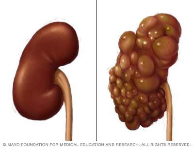 Tesevatinib: Polycystic Kidney Disease Pathophysiology Tesevatinib is uniquely positioned to be a first-in-class drug to treat ADPKD and ARPKD Most prevalent monogenic