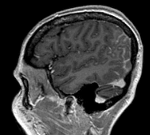 Parieto-Occipital Leptomeningeal
