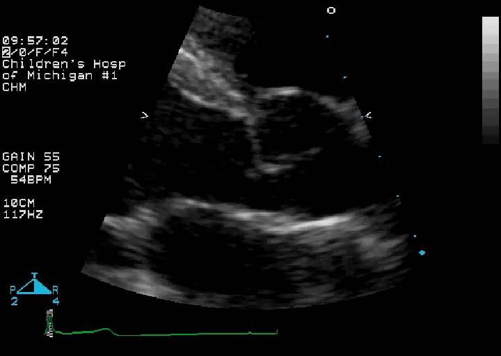 Question 10 - A common complication of this defect is: 1. Pulmonary valve endocarditis 2.