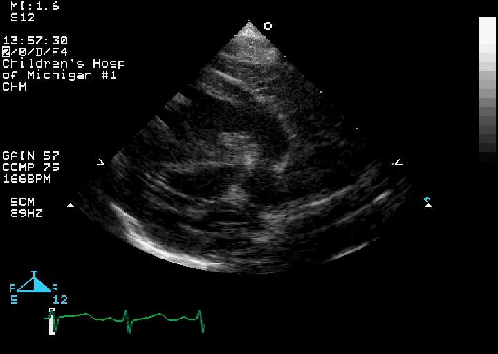 Case 6 Asymptomatic 3 month old with cyanosis and a cardiac murmur