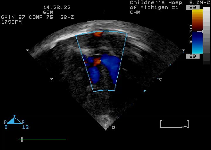 Case 6 Asymptomatic 3 month old with cyanosis and a cardiac murmur The defect shown in this example is: 1.