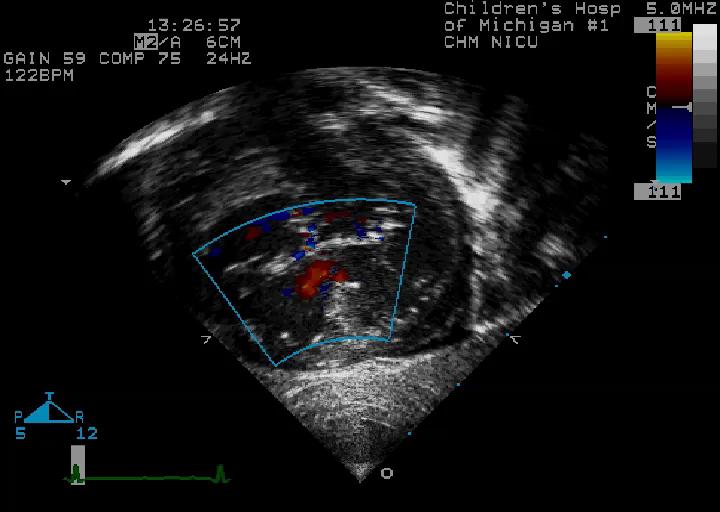 Case 9 Complete AV Canal AV Septal Defects Physiology Physiology dependent on which components of AV septal defect are present If 1 ASD and no VSD - physiology similar to isolated ASD