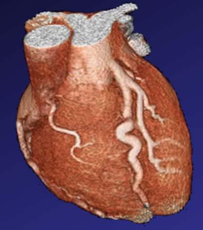 Anomalous Left Coronary Artery From the Pulmonary Artery - ALCAPA Rare congenital anomaly Usually presents at 2-3 m of age Results in severe LV ischemia Present as dilated CM, CHF ECG often