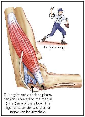 Ulnar Collateral Ligament Injuries Chronic valgus stress places