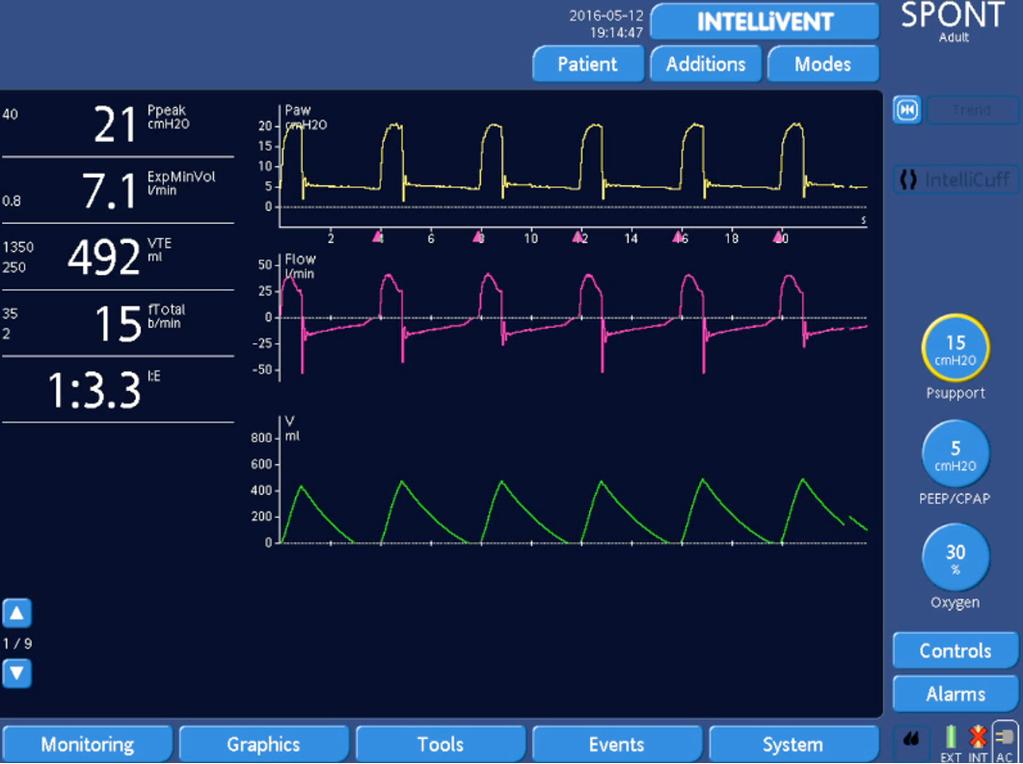 Figure 17: The same patient after activation of IntelliSync+.