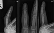 ER side of Hand OR side of Hand Chronic osteomyelitis after a fight bite Summary Thorough physical examination and imaging are critical Recognize problem fractures among seemingly