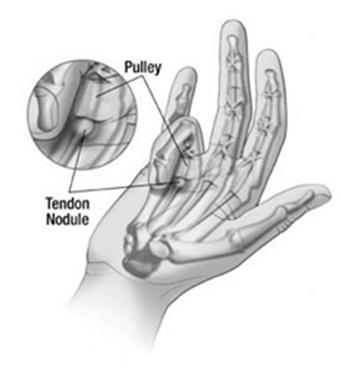 Flexor Tendon Pulley System A1 pulley is site of trigger finger More