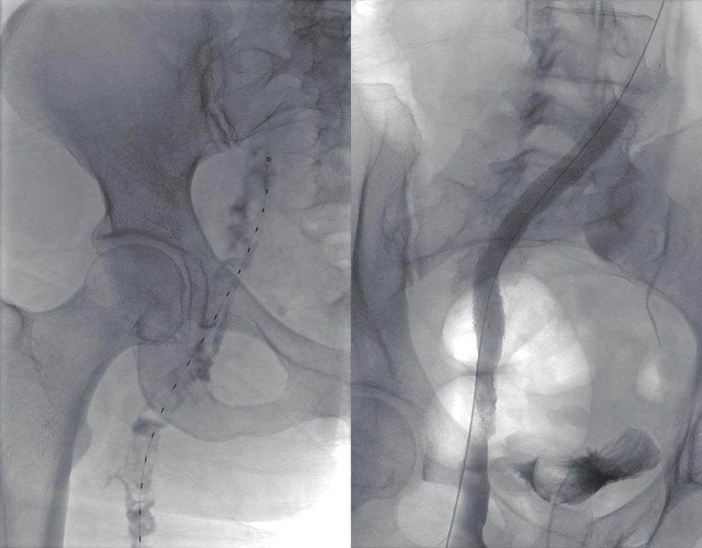 S232 Fleck et al. CDT of DVT A Figure 1 Thrombosis of the left common iliac vein treated with PCDT and stenting.