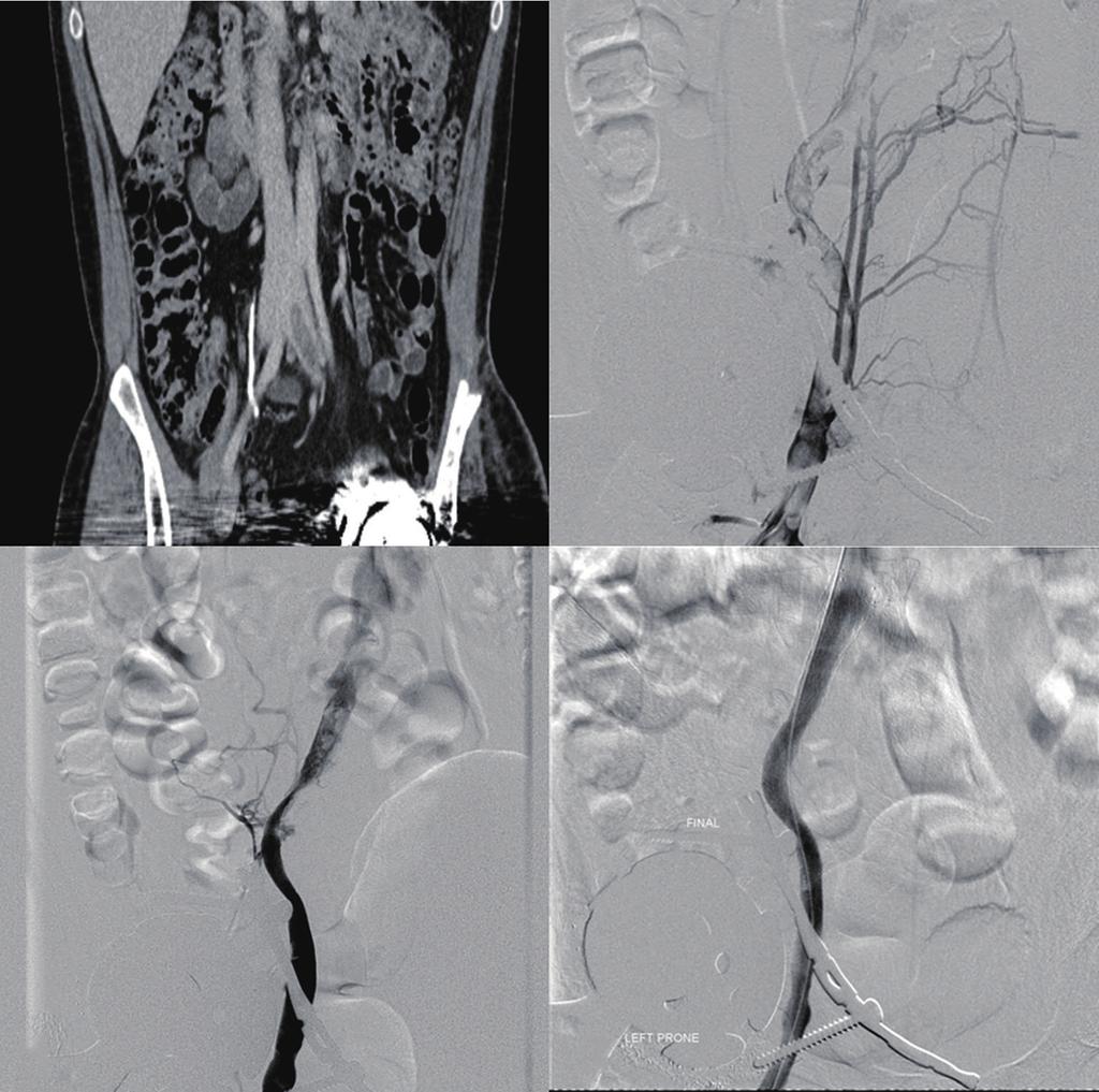 S234 Fleck et al. CDT of DVT A B C D Figure 2 PCDT with angioplasty and stenting.