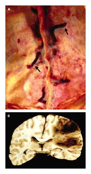 Postmortem Views of Sinus