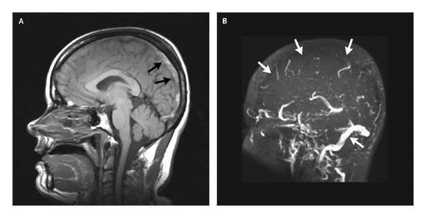 MRI of Sinus Thrombosis. Stam J.