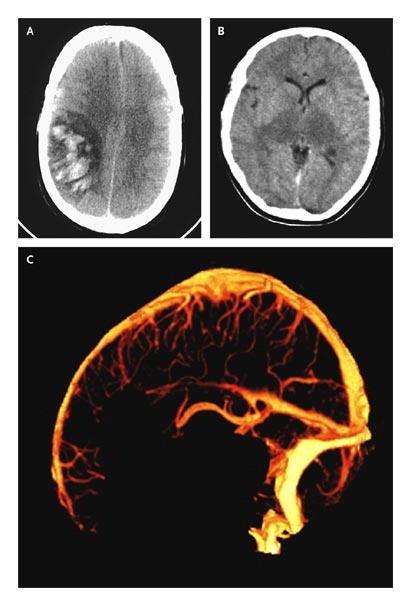 CT Imaging of Sinus Thrombosis. Stam J.