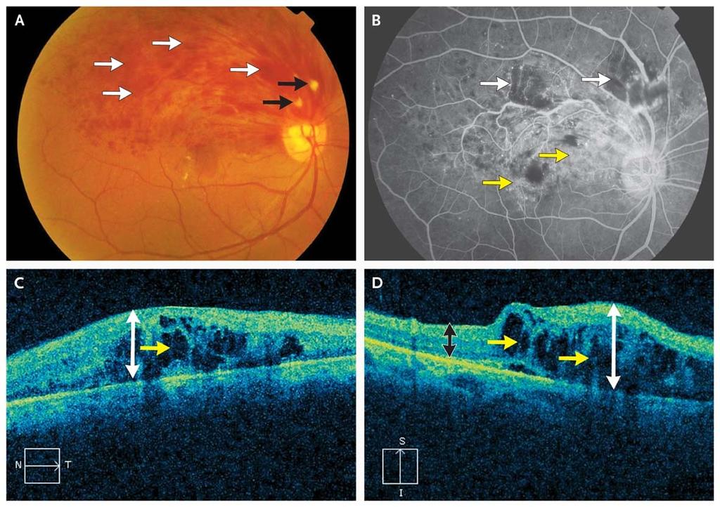 Branch Retinal-Vein Occlusion in the