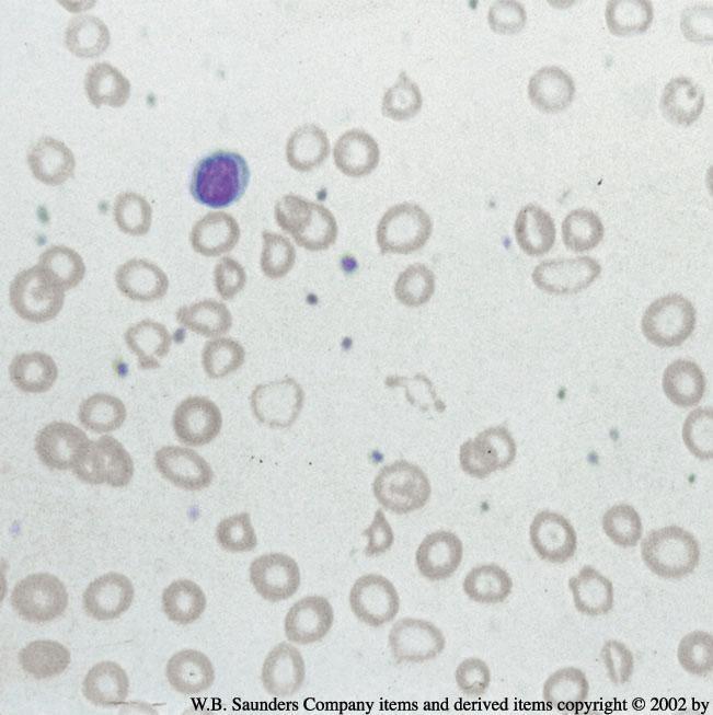 Microcytic Anemia any RBCs smaller than nucleus of normal lymphocytes ncreased central pallor.
