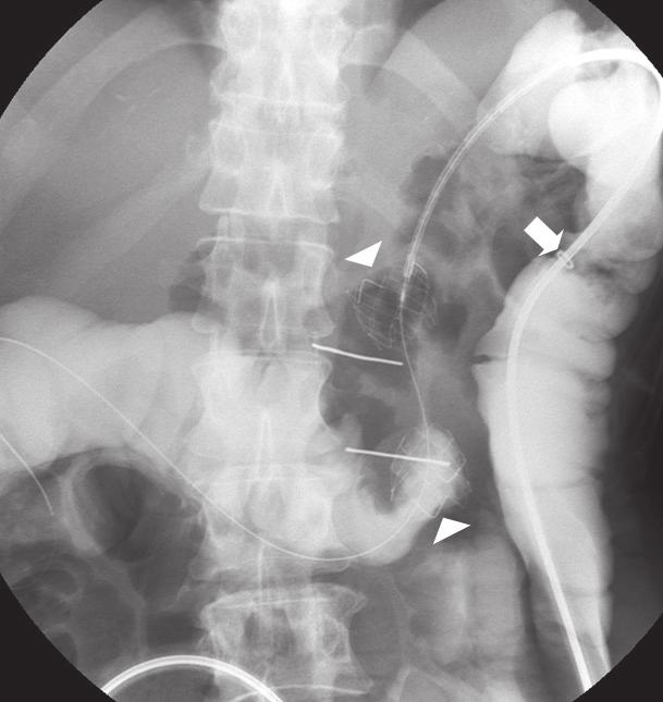 Radiographs obtained before and during stent placement in patient with recurrent gastric cancer involving middle portion of transverse colon. A.