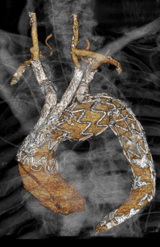 4 Ferrer and Cao. Endovascular arch replacement with a dual branched endoprosthesis including a mean intensive care unit stay of 1.5 [1 3] days. No early reintervention was performed.