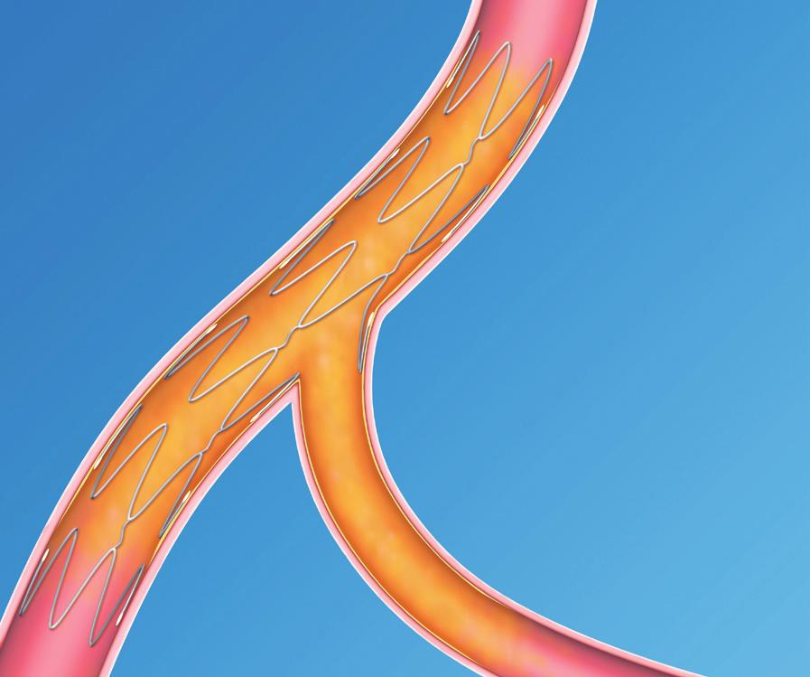 A versatile tool for treating bifurcation lesions Pre-treatment: AngioSculpt placed at side branch in bifurcation lesion Post-treatment: AngioSculpt used as stand-alone treatment in side branch and