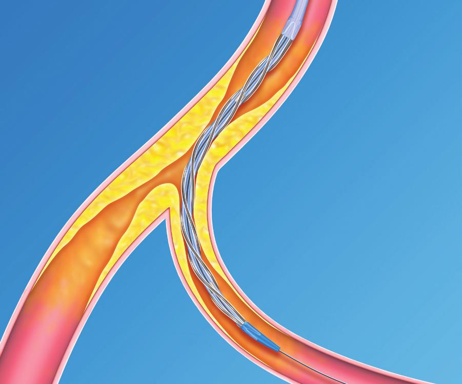 AngioSculpt offers physicians an effective, time-saving tool for treating the unique challenges of bifurcation lesions.