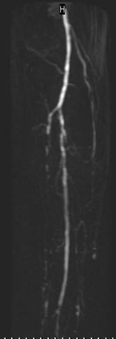 Endovascular strategy Treating angiographic images =