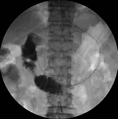 a b c Figure 2. a c. A 67-year-old male patient with acute pancreatitis at six days after stent placement.