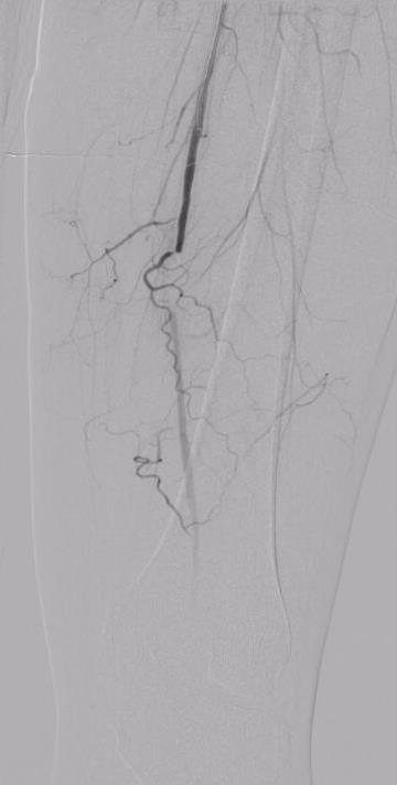 Stenting - Case