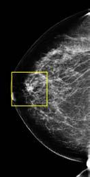 in fact normal breast tissue that was overlapping in the traditional mammogram creating the illusion of an abnormal
