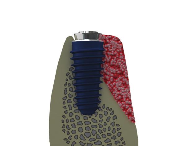REGENERATION 184/185 1. How to use Ideal + Regeneration membrane i-gen membrane 1. Place an implant into the recipient site. 2. Connect a i-gen screw to the implant and bone grafting.