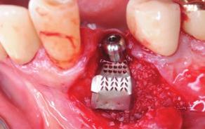 A Healing Abutment was connected on the