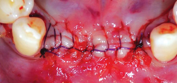 Case Ⅲ. Mandibular incisor area Fig 1.