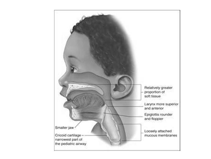 Position Epiglottis Rounder and Floppy Cricoid Ring is the