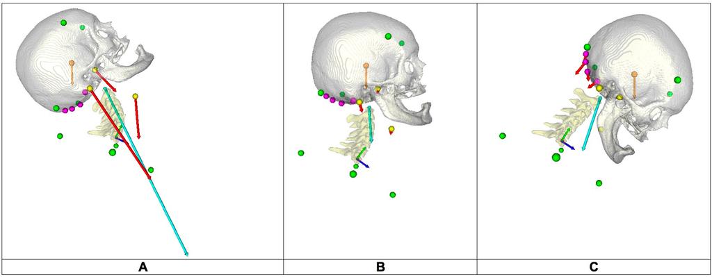 Figure 37: The skull and cervical spine model in an extended orientation (A), in the neutral position (B), and in a flexed orientation (C).