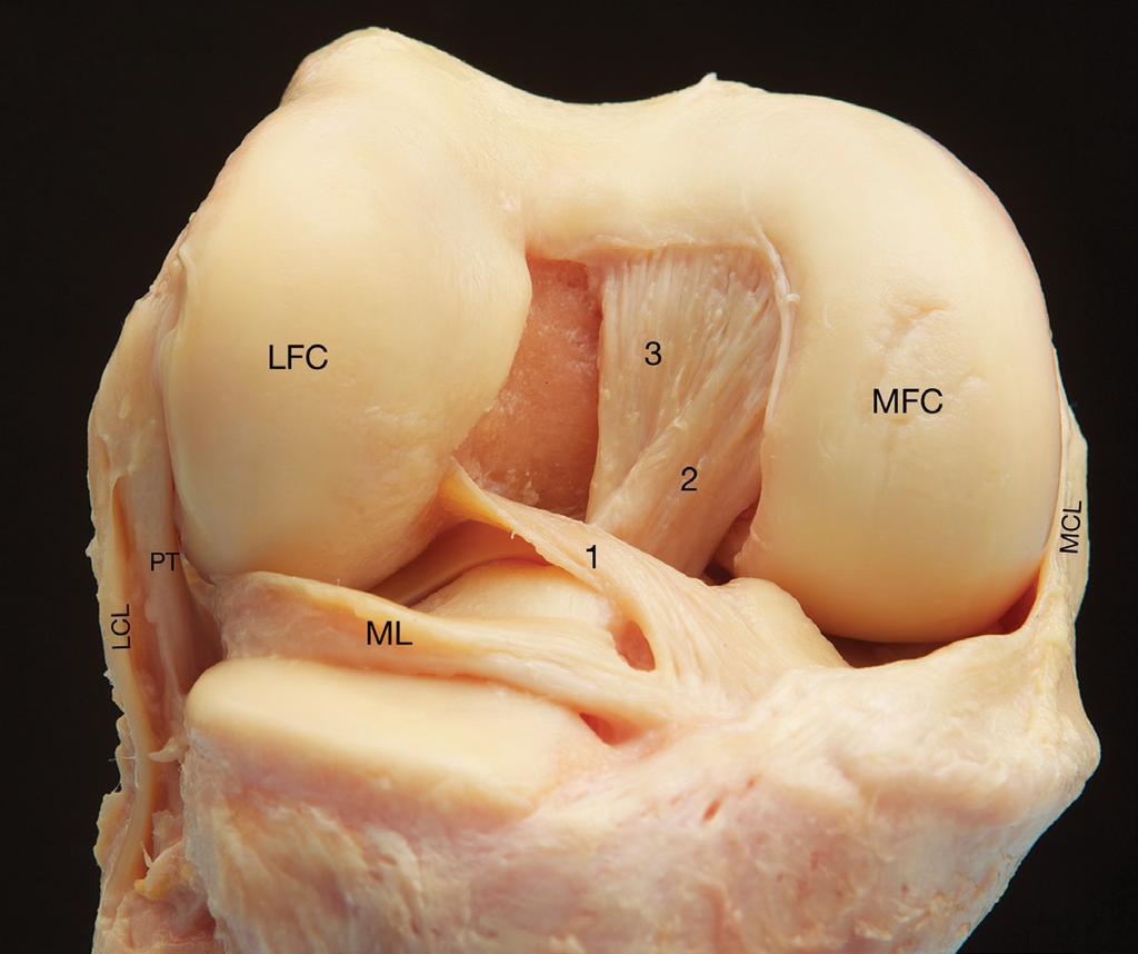 1a 1b 2a 2b Figure 1: (a) Cadaveric dissection of right knee joint, patella is removed, view from the front.