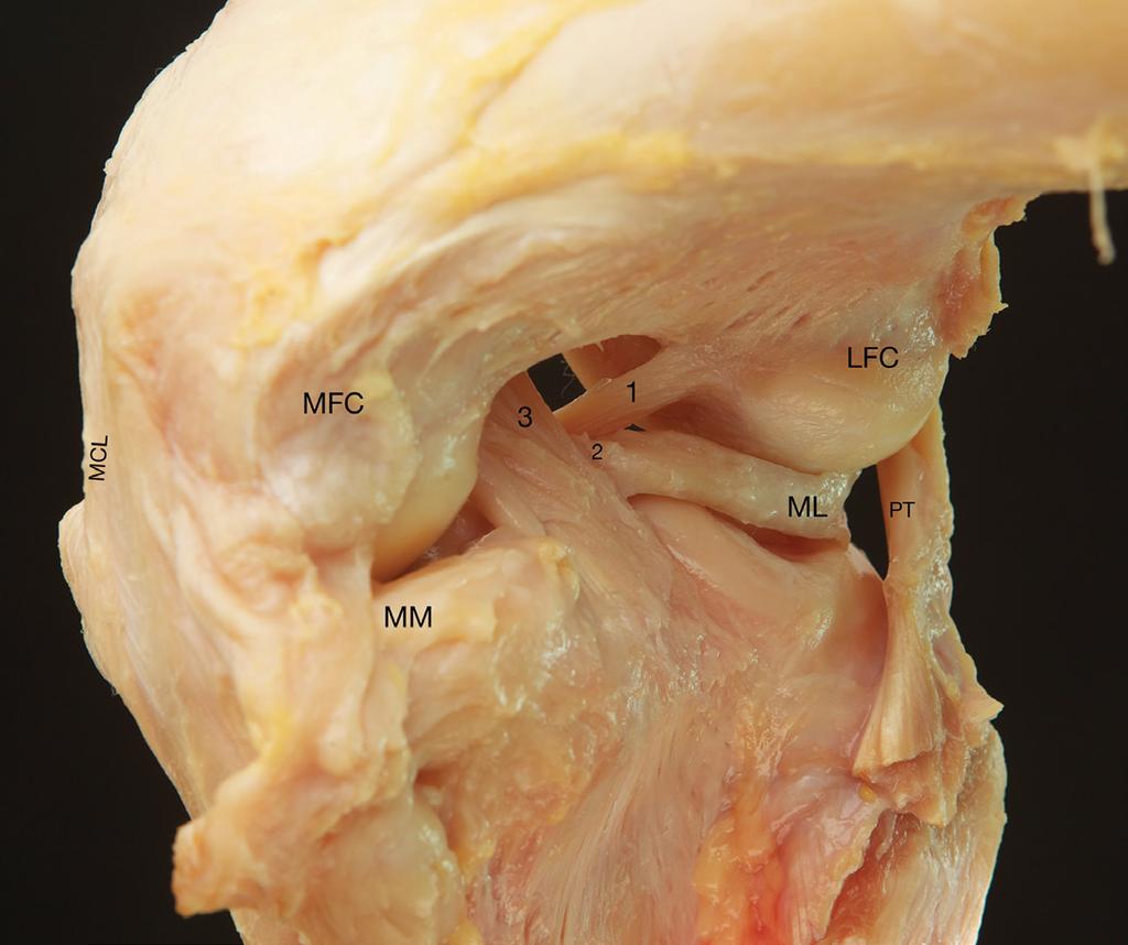 2=anterior menisco-femoral ligament (Humphrey ligament), 3=posterior cruciate ligament.