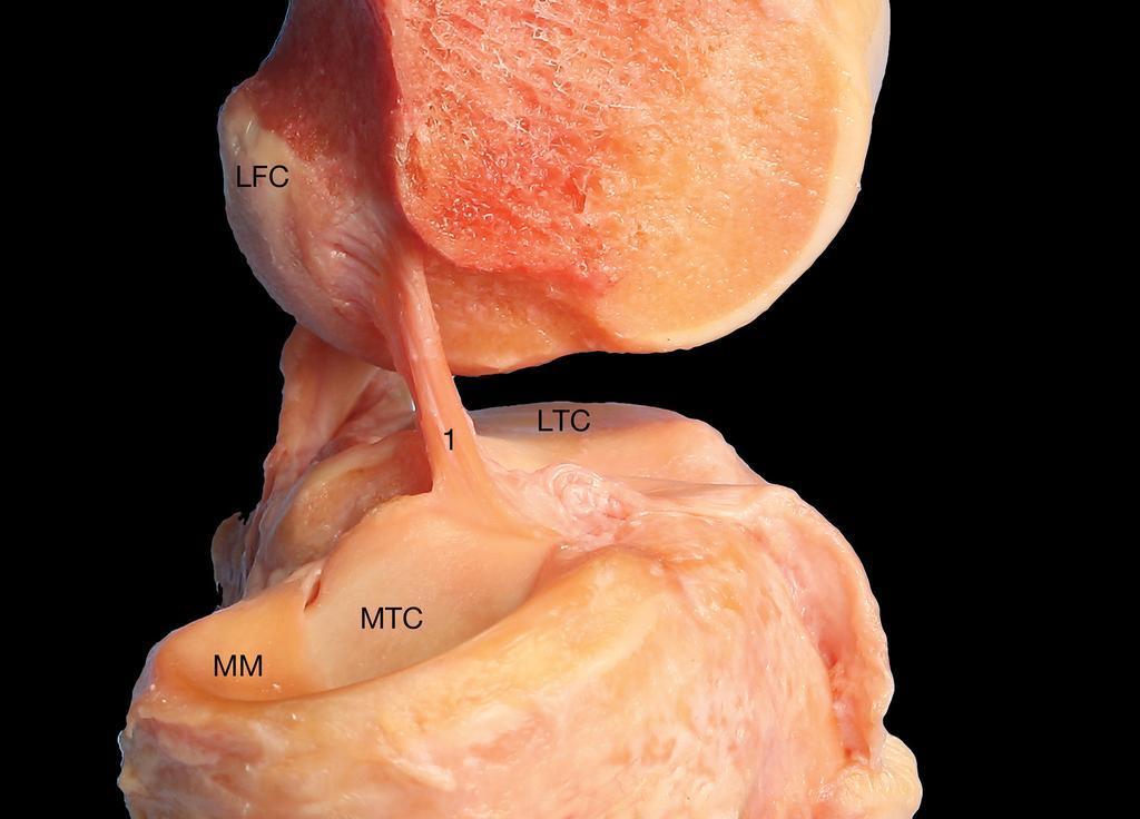 Figure 2: (a) Cadaveric dissection of the left knee joint, medial femoral condyle is removed.