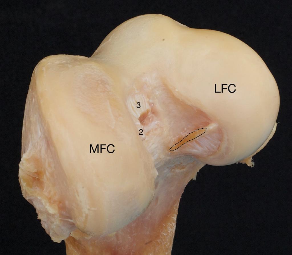 SPORTS SURGERY 3a 3b 3c 4a Figure 3: Cadaveric dissection of the left knee joint, distal femur, antero-inferior view.