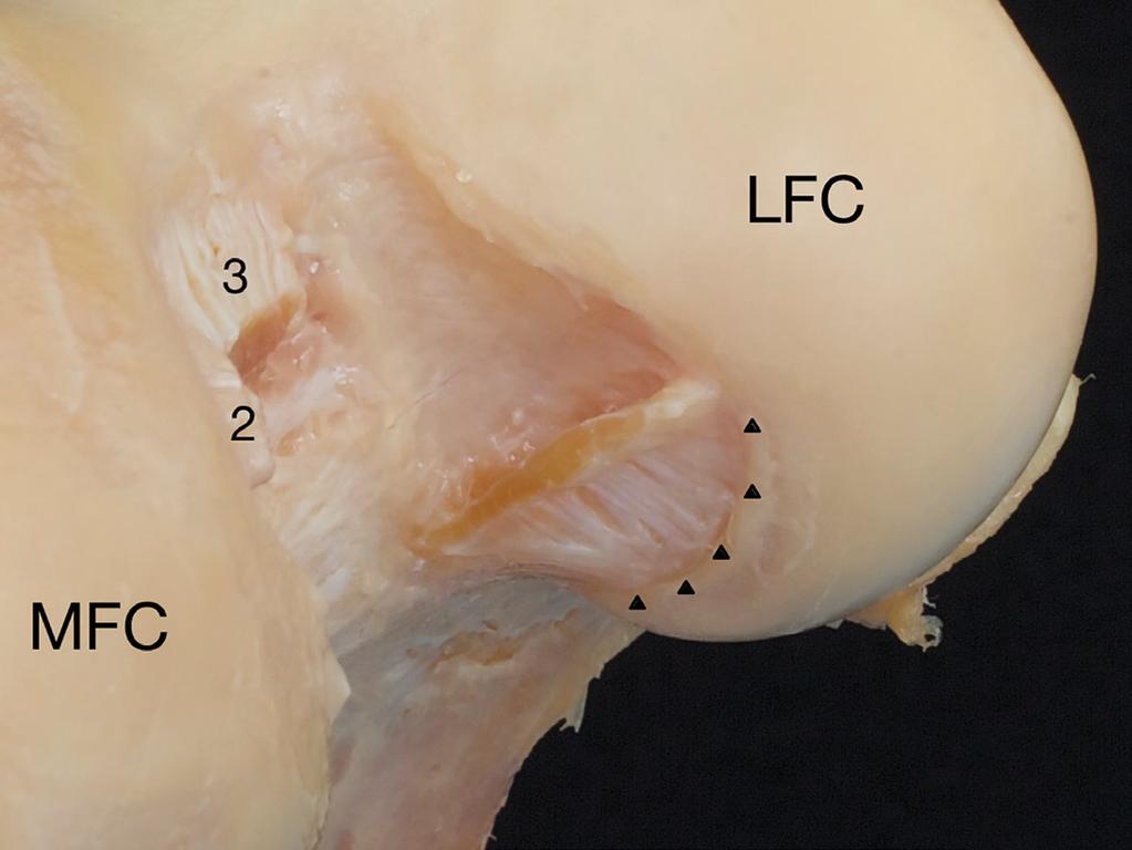 ligament (Humphrey ligament), 3=femoral attachment of posterior cruciate ligament. (b) Same view.