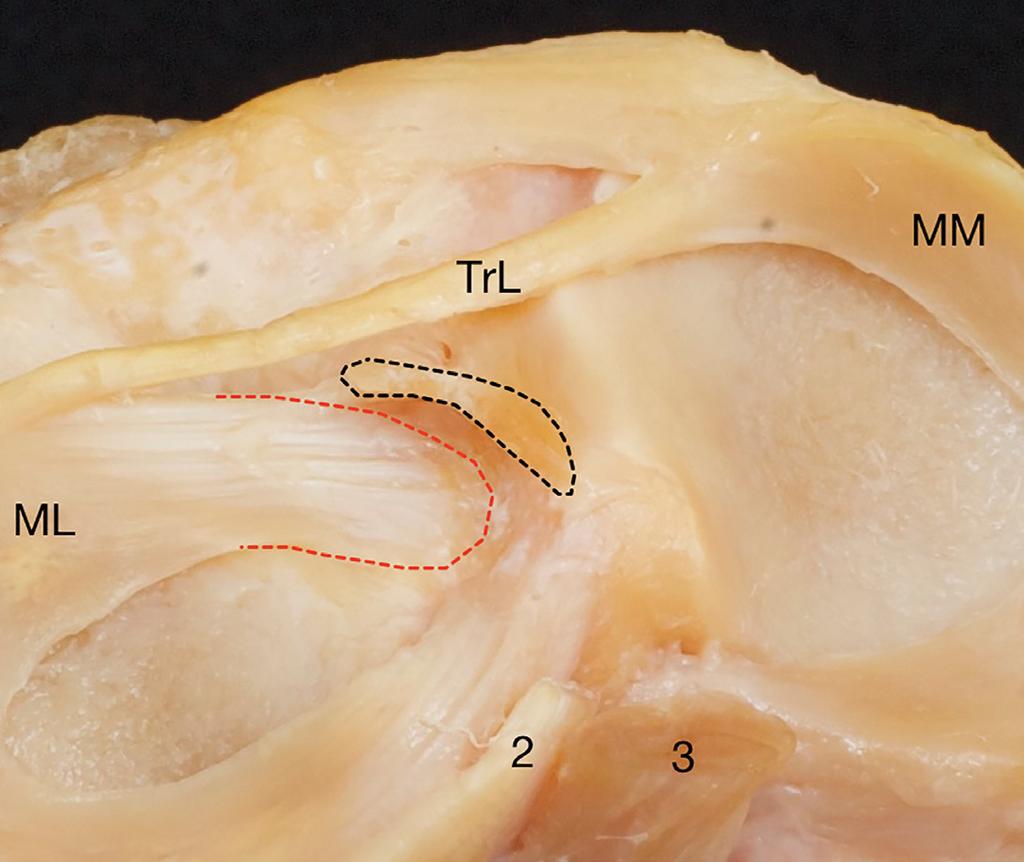 For example with hamstring tendon graft and endo-button fixation, the center of the tunnel should be the centre of the insertion.