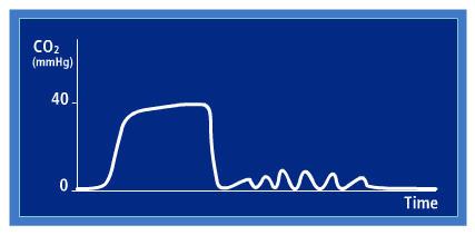 Sudden loss of waveform to zero or near zero indicates that no breath is
