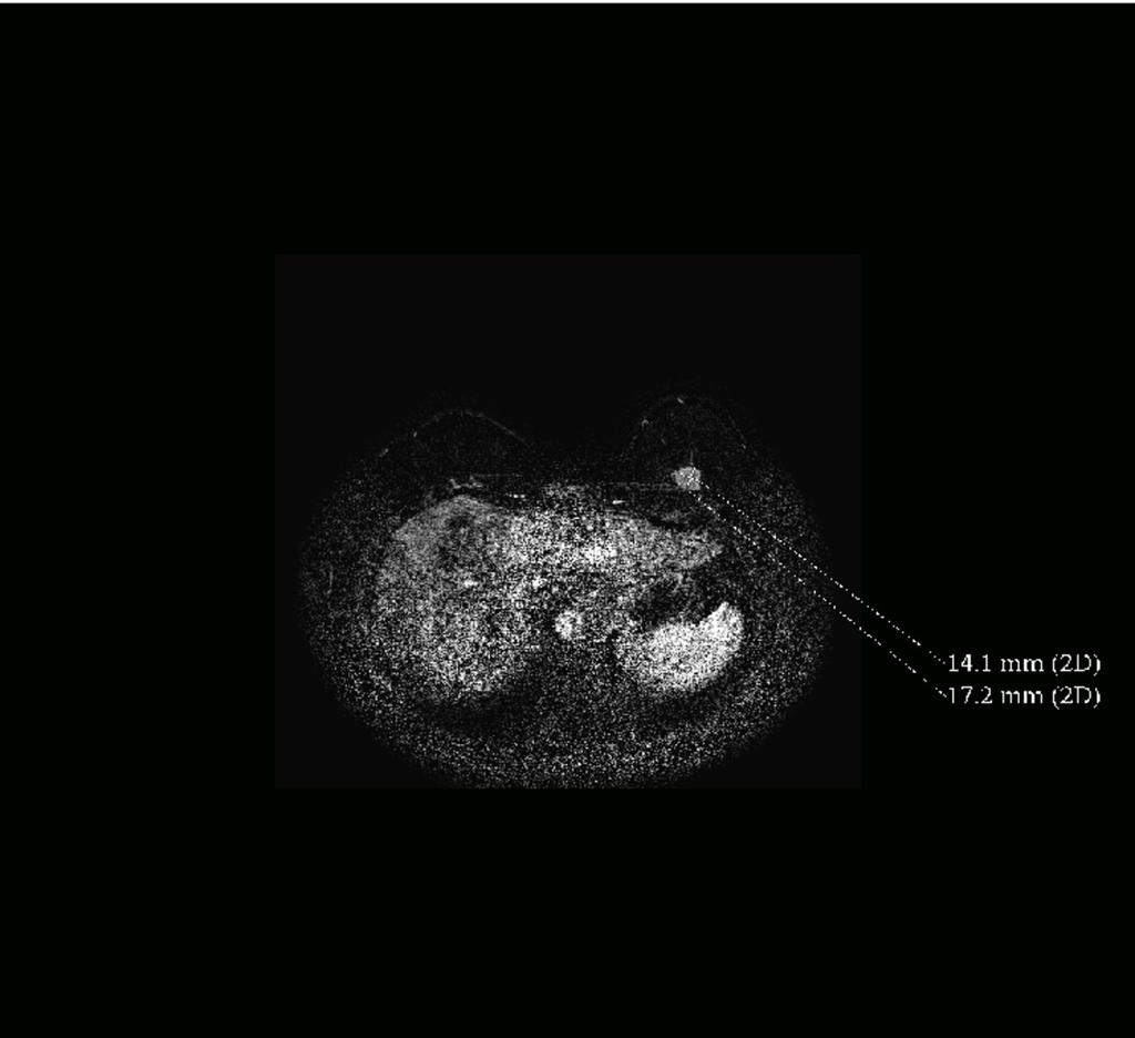 Fig. 5: Case 2: Axial MRI shows biopsy