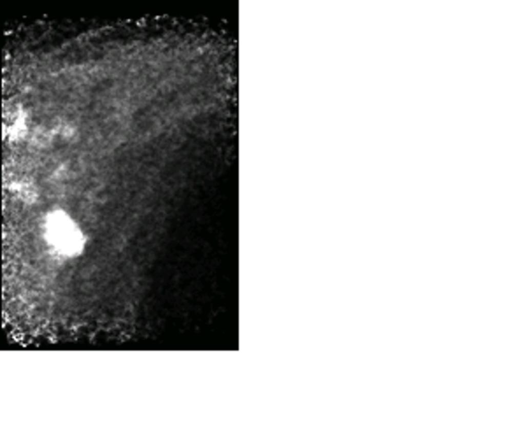 Fig. 9: Case 2: PEM left axillary view shows