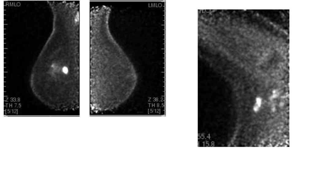 Fig. 10: Case 3: (extreme left image) Right MLO PEM scan shows intraductal carcinoma in the right breast with peritumoral