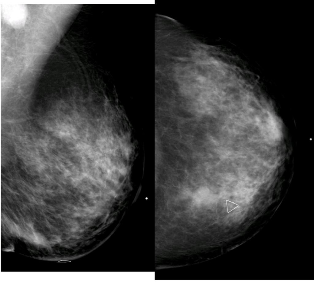 Fig. 2: Case 1: Left MLO, CC Mammogram 2.