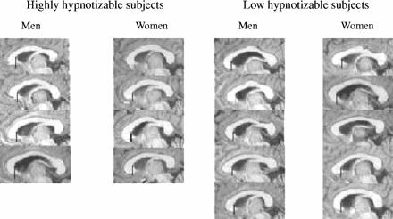 Pain and Hypnosis Increased anterior corpus callosum size is associated positively with hypnotizability and the ability to control pain These results suggest that highly hypnotizable