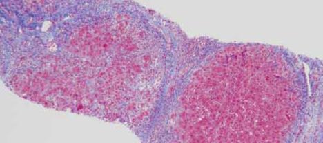 (F4) Advanced cirrhosis showed regenerative nodules separated by fibrous tissue bands containing inflammatory cells mainly